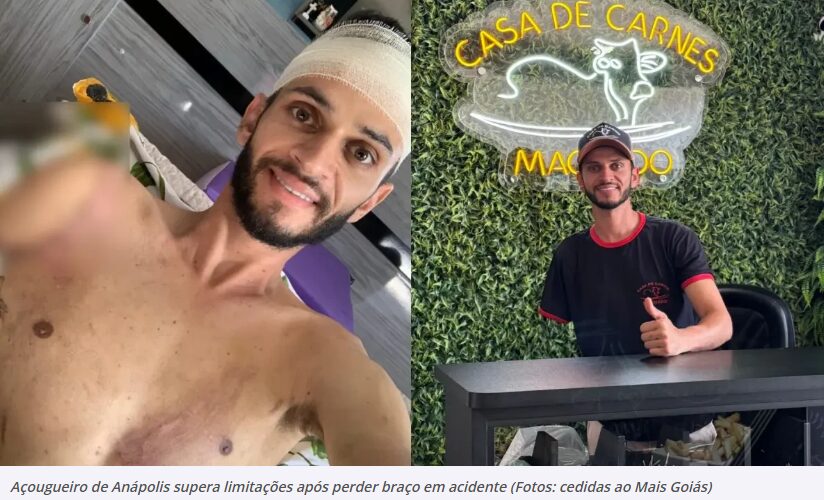 Açougueiro supera dependência e cria técnicas para seguir na profissão após perder braço em Anápolis